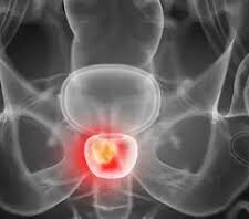 Dr. Pienta on the evolving paradigm of PSMA-PET imaging