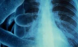 Legionnaire’s disease cluster reported in Gaston County