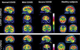 What We Know About Covid’s Impact on Your Brain