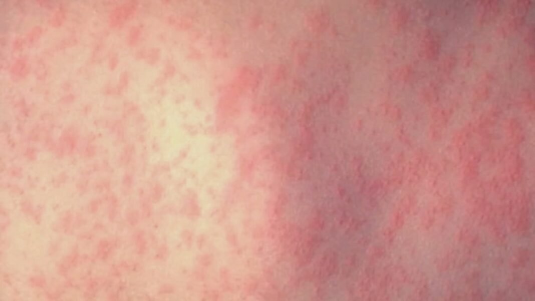 CDC updates measles death