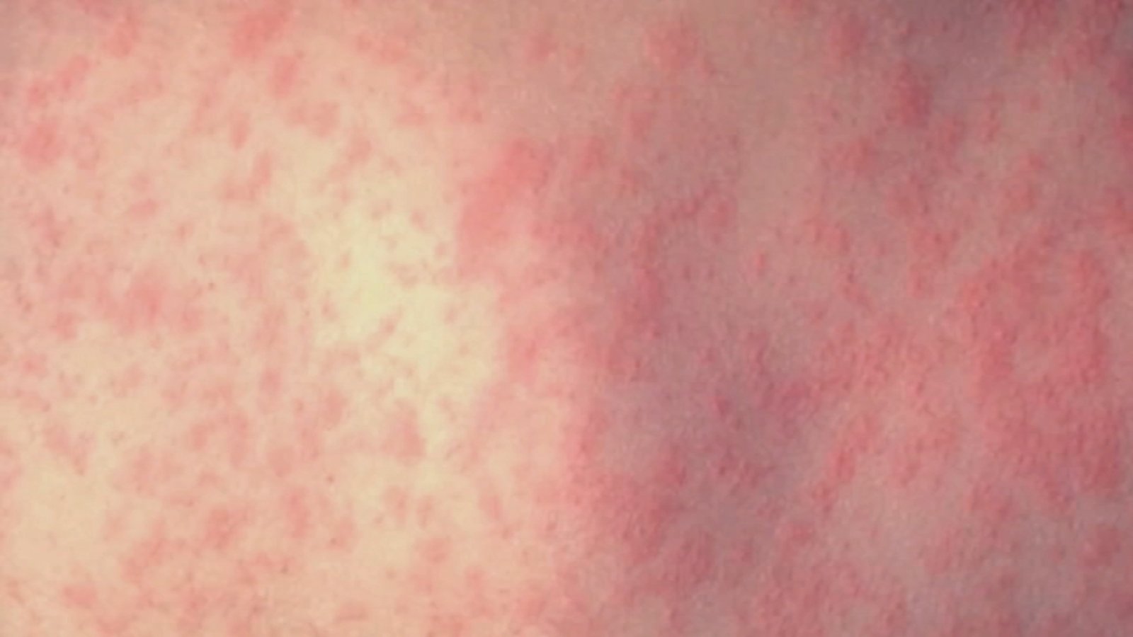 CDC updates measles death
