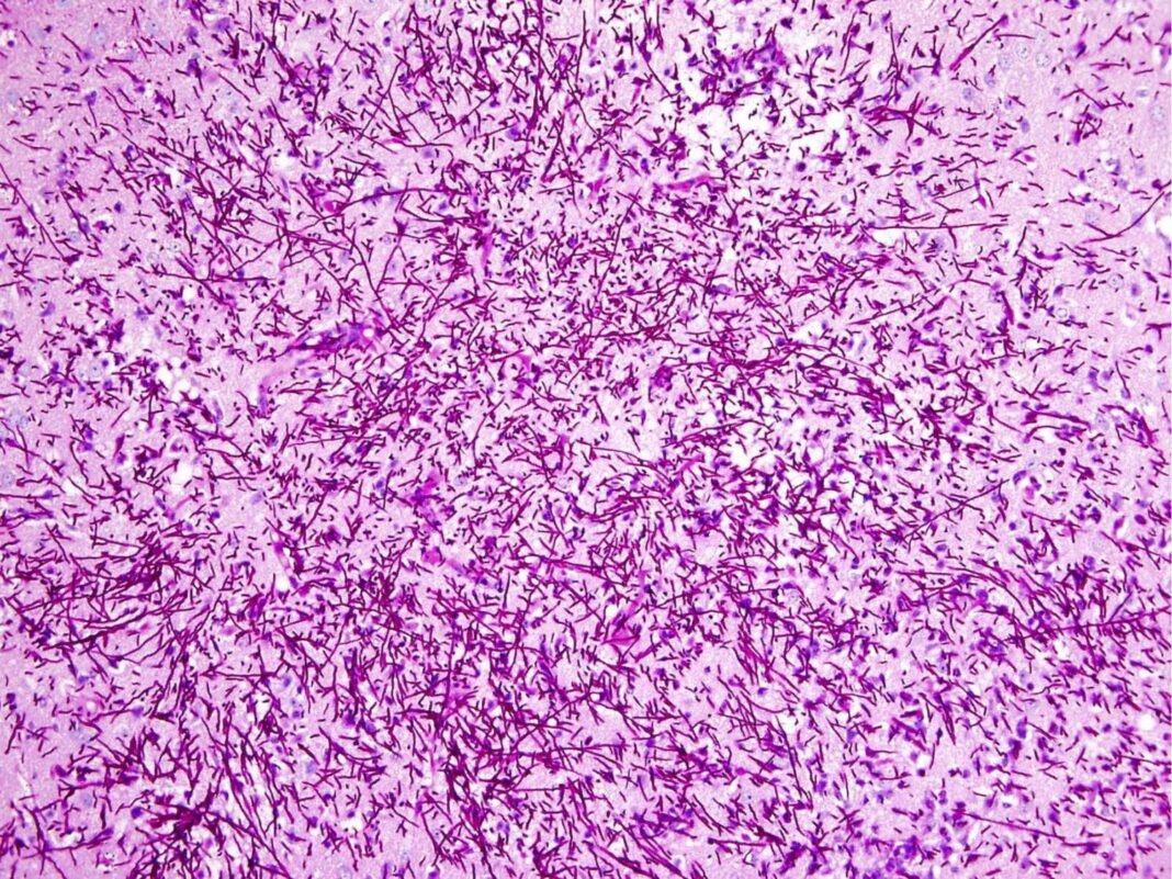 14-wp-health A laboratory sample representing the deadly brain fungus infections rising across America, shown against neural imagery.