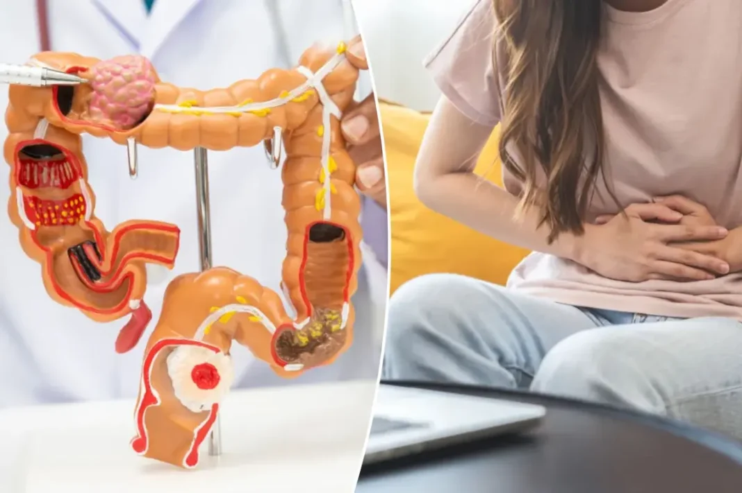 Colorectal cancer rates are