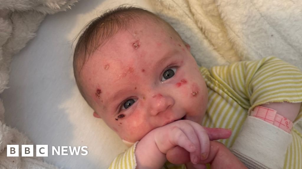 Epidermolysis bullosa: was told