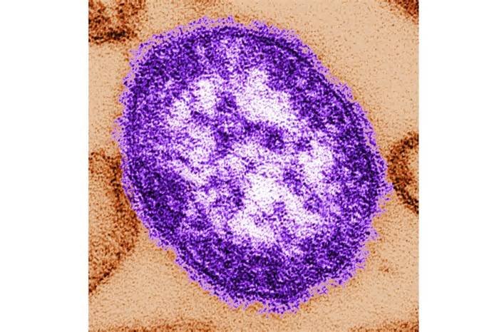 measles case confirmed in