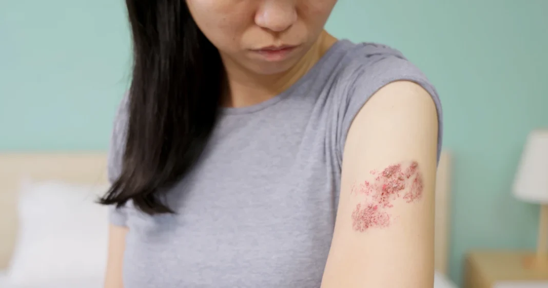 Shingles cases dropping among