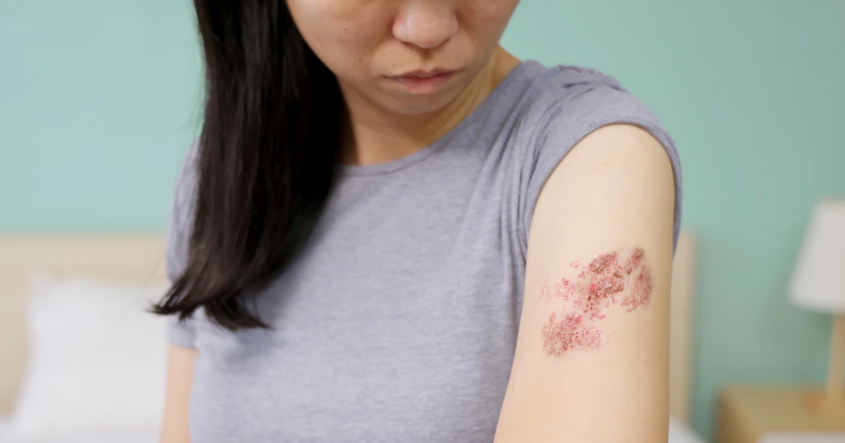 Shingles cases dropping among